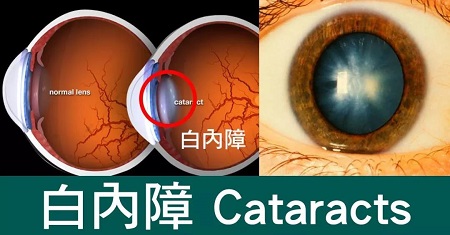 有了白内障该怎么办？