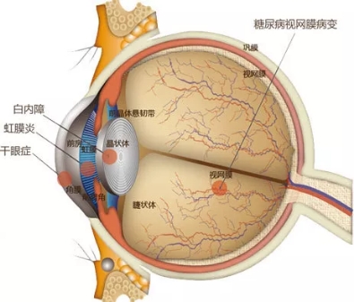 吸烟会增加患糖尿病视网膜病变的风险吗？