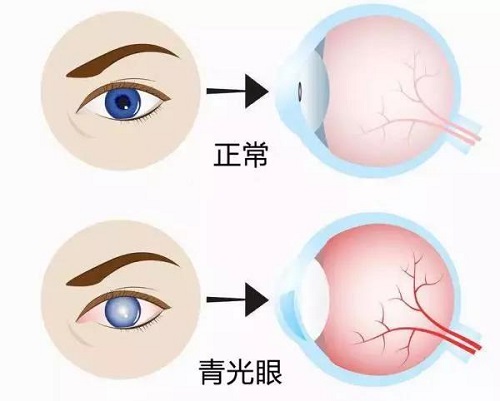 年轻人会得青光眼吗？