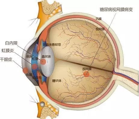 糖网病有哪些症状？