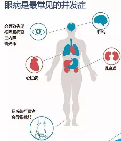 糖尿病会引起哪些并发症？