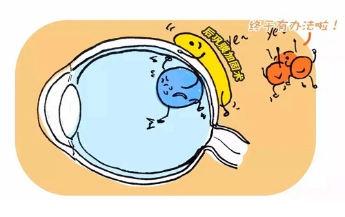 近视度数增长过快可以做后巩膜加固术