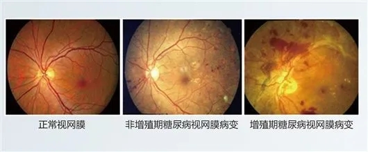 高糖油腻食物会造成糖尿眼病吗？