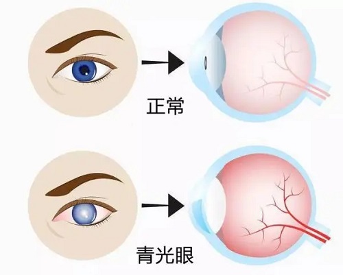 高度近视会导致青光眼吗？