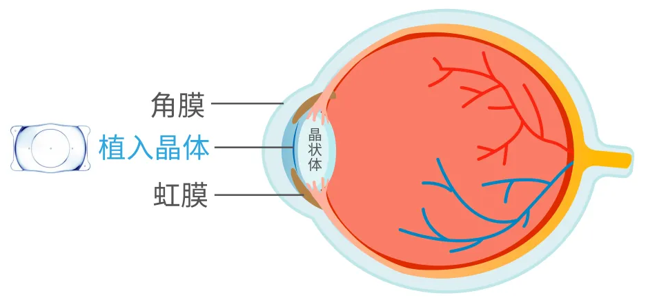 高度近视