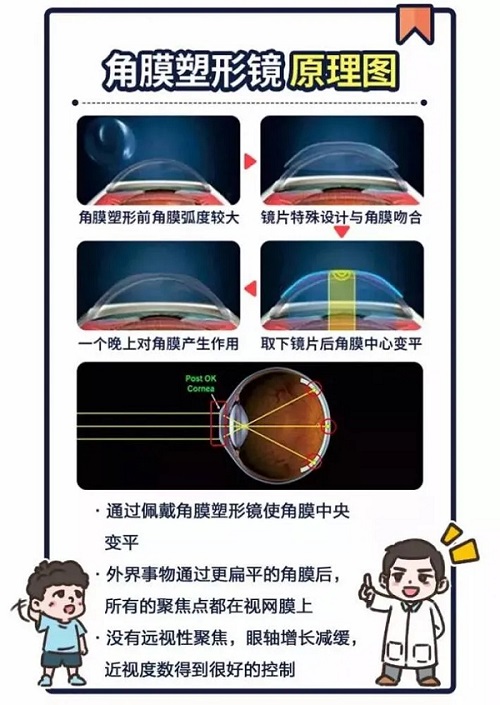 儿童近视